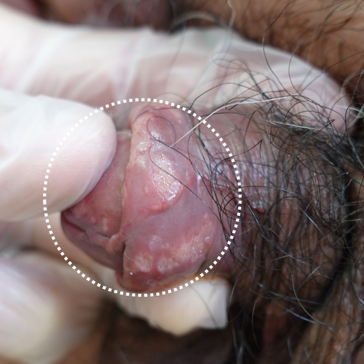 悪臭と多発潰瘍を伴った性器ヘルペスの一例