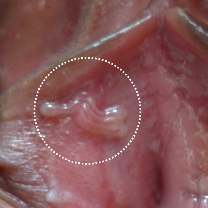 アソコのいびつなでこぼこが気になり、受診された膣前庭乳頭腫症の一例